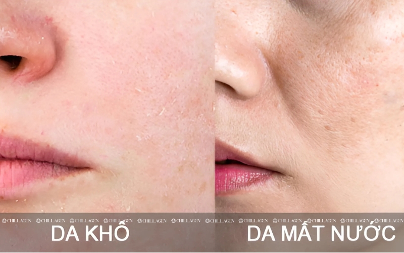Cách phân biệt da khô và da thiếu nước – Đâu là nguyên nhân và giải pháp? 1 phân biệt da khô và da thiếu nước