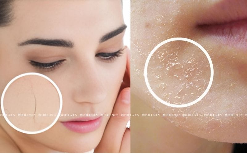 Cách chăm sóc da khô: 5 nguyên tắc giúp da khỏe từ bên trong