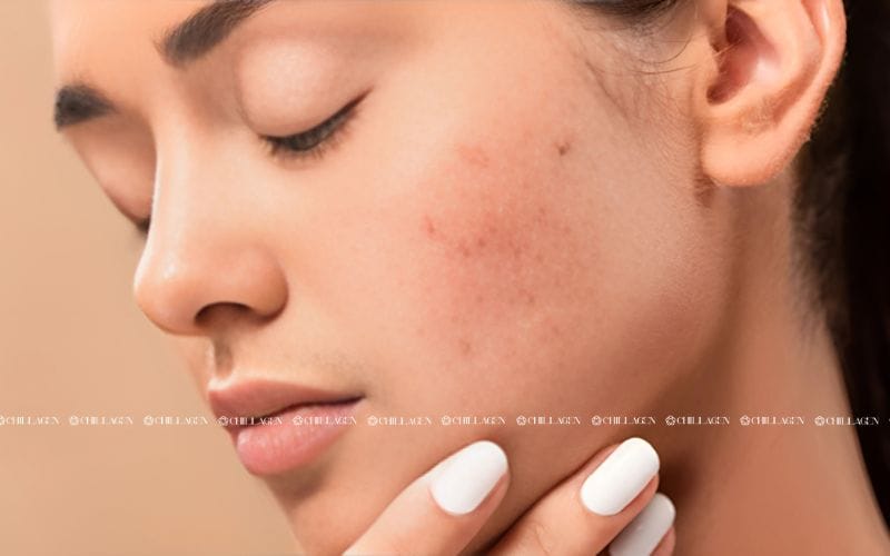 Trà hoa vàng kháng viêm – Giải pháp tự nhiên cho sức khỏe và làn da 2 Trà hoa vàng kháng viêm