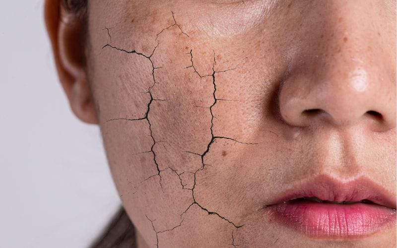 Cách chăm sóc da khô sạm hiệu quả: Lấy lại làn da mịn màng và rạng rỡ