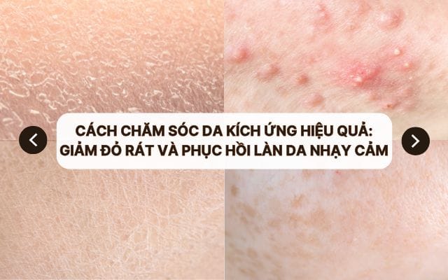 cach cham soc da kich ung