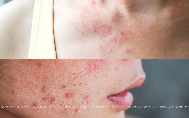 Da nổi mẩn do nội tiết phải làm sao? Giải pháp chăm sóc da và cân bằng từ bên trong