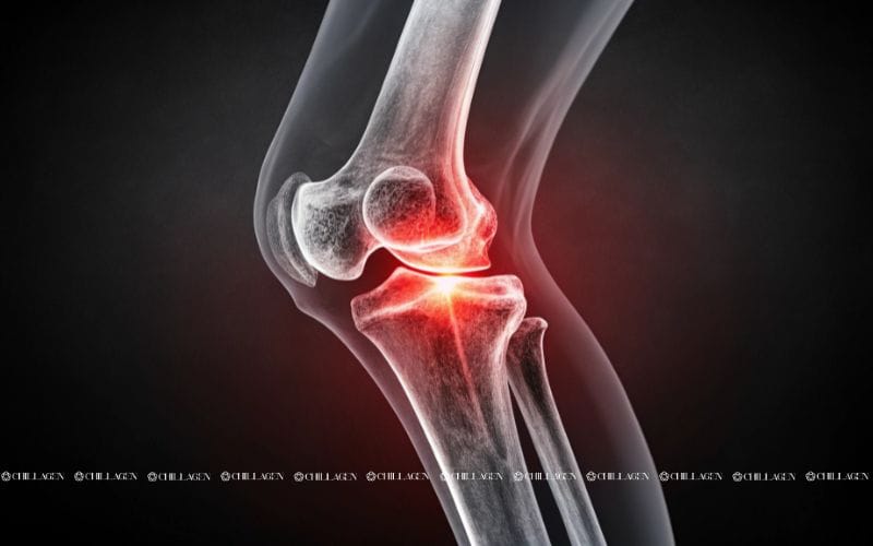 Cách phòng ngừa bệnh viêm khớp: Bảo vệ xương khớp từ sớm