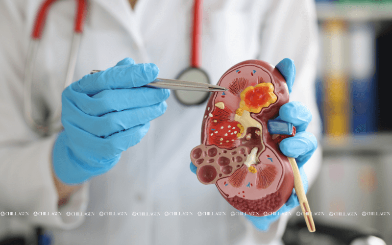 Cách phòng ngừa bệnh suy thận: Bảo vệ chức năng thận từ sớm 6 Cách phòng ngừa bệnh suy thận: Bảo vệ chức năng thận từ sớm